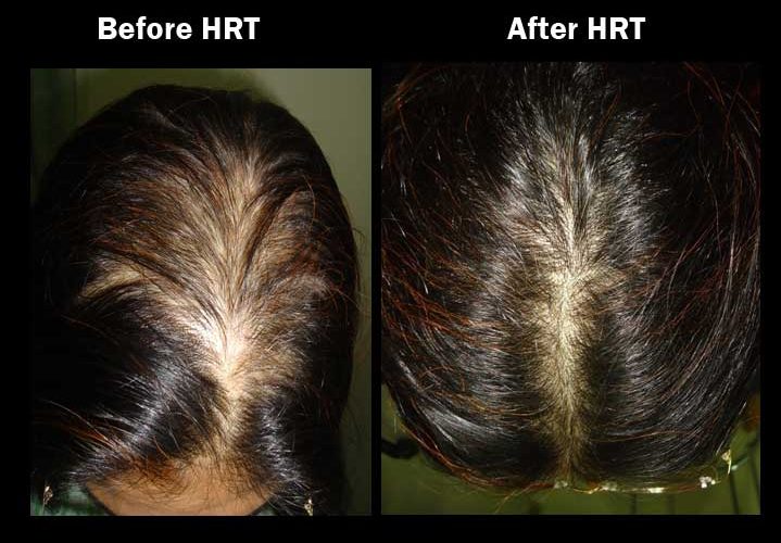 کاشت مو به روش HRT
