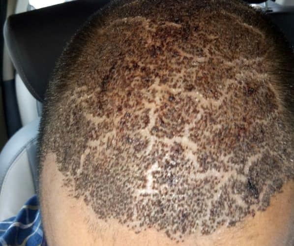 ترک پوست سر و پوسته پوسته شدن سر بعد از کاشت مو