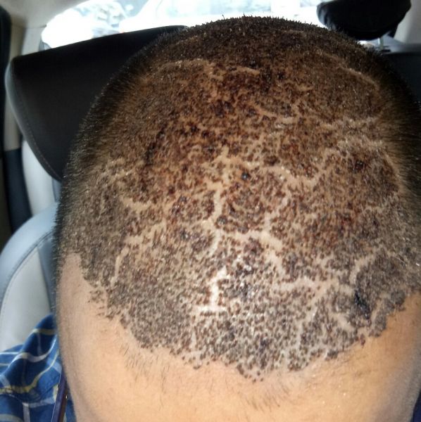 ترک پوست سر و پوسته پوسته شدن سر بعد از کاشت مو