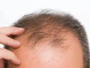 کاشت مو توسط سلول های بنیادی