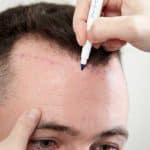 کاشت مو به روش DHI چیست و عوارض و مزایای آن چکونه است