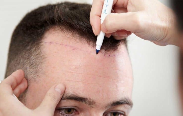 کاشت مو به روش DHI چیست و عوارض و مزایای آن چکونه است