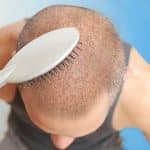 شانه زدن بعد از کاشت مو