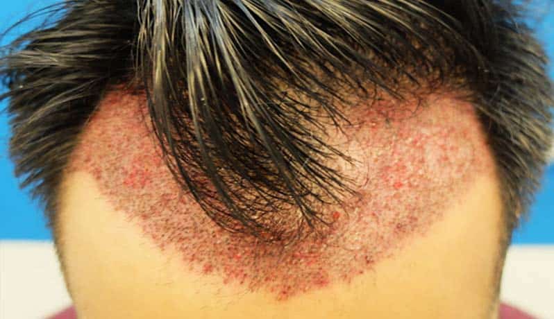 قرمزی پوست سر و راههای درمان بعد از کاشت مو