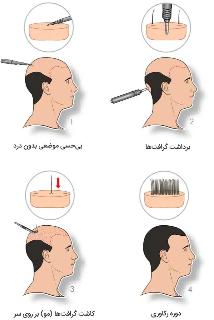 مراحل اولیه کاشت مو