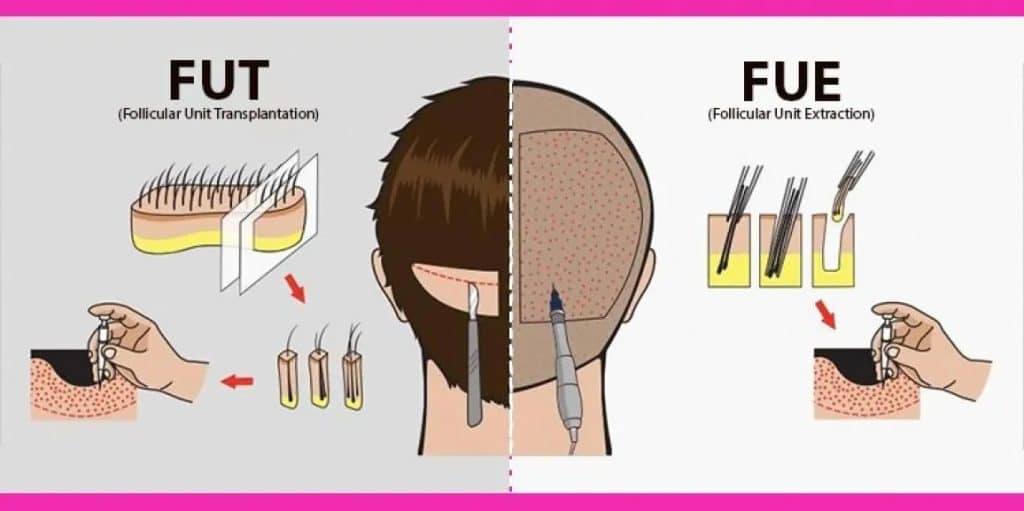 جراحی کاشت مو  با دو روش FUT و FIT