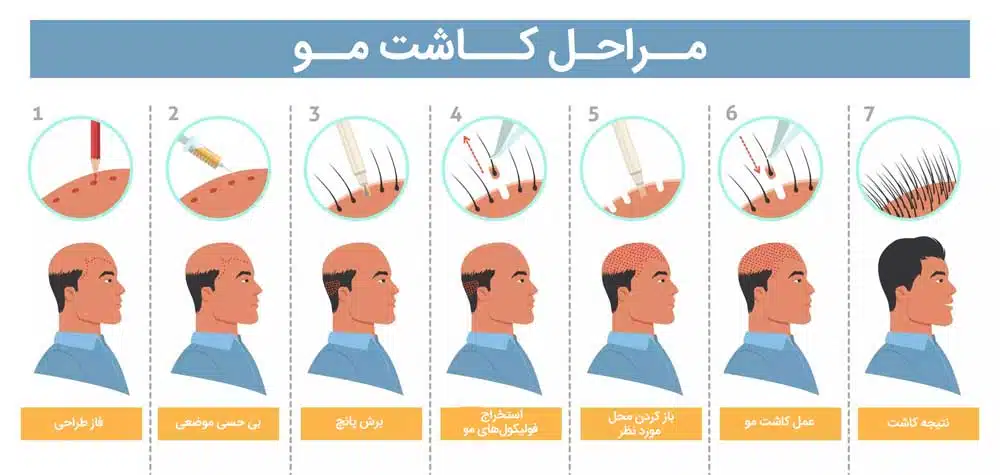 مراحل و نتایج نهایی کاشت مو