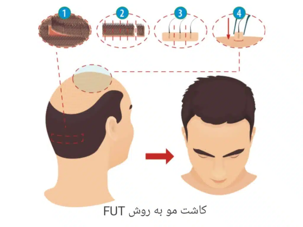 گرافت مو در کاشت مو