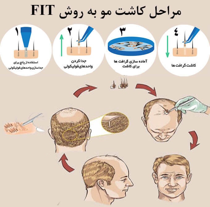 مراحل کاشت مو به روش fit