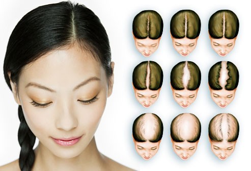 ریزش موی زنان در بالای سر